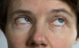 Dystonie van de oogspieren: oculogyre crisis