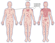 Het stevens-johnsonsyndroom en toxische epidermale necrolyse